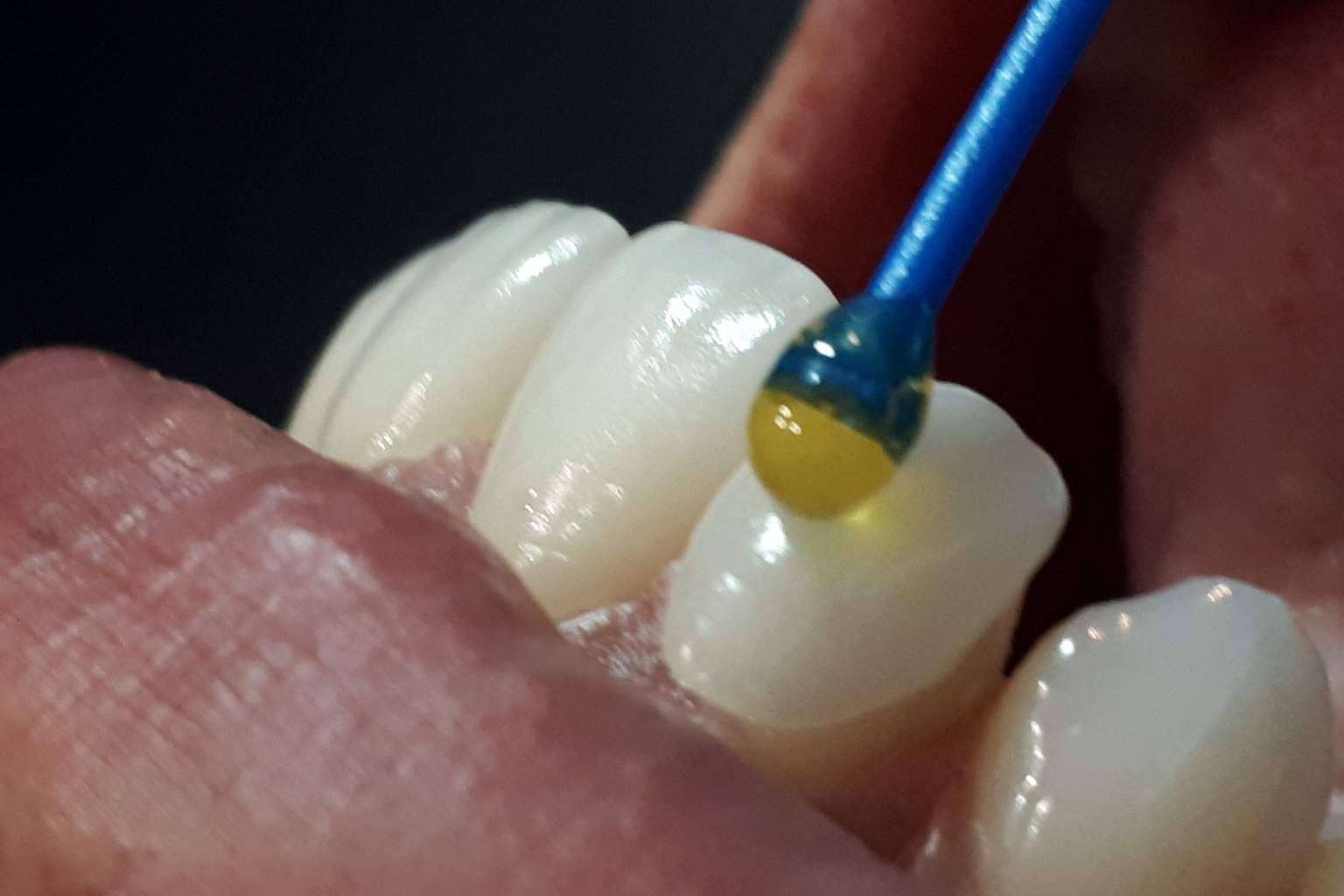 Conseguir una sonrisa Hollywood gracias a los servicios de Dentinova