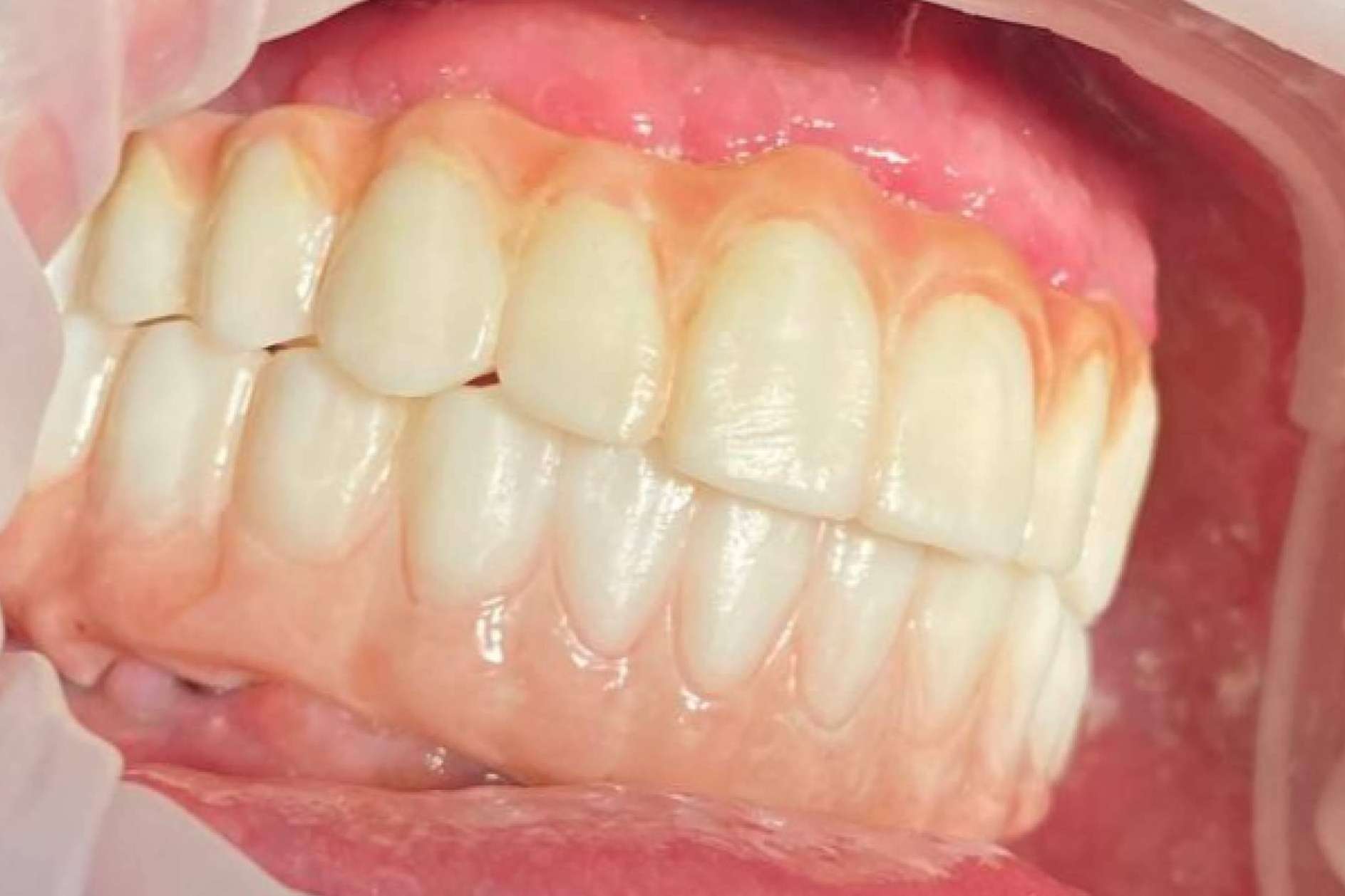 Dientes en un día es posible con la impresión 3D, por Dentinova