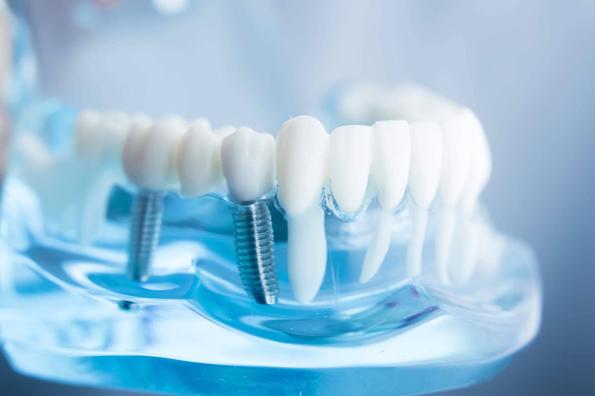 Dentinova, las consecuencias de la pérdida de un diente