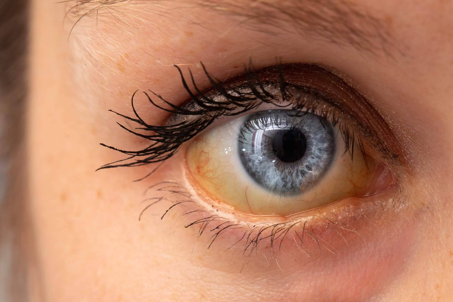 ¿Cuáles son las causas de los ojos amarillos y dónde tratarlos?, el Instituto Oftalmológico Dexeus lo explica