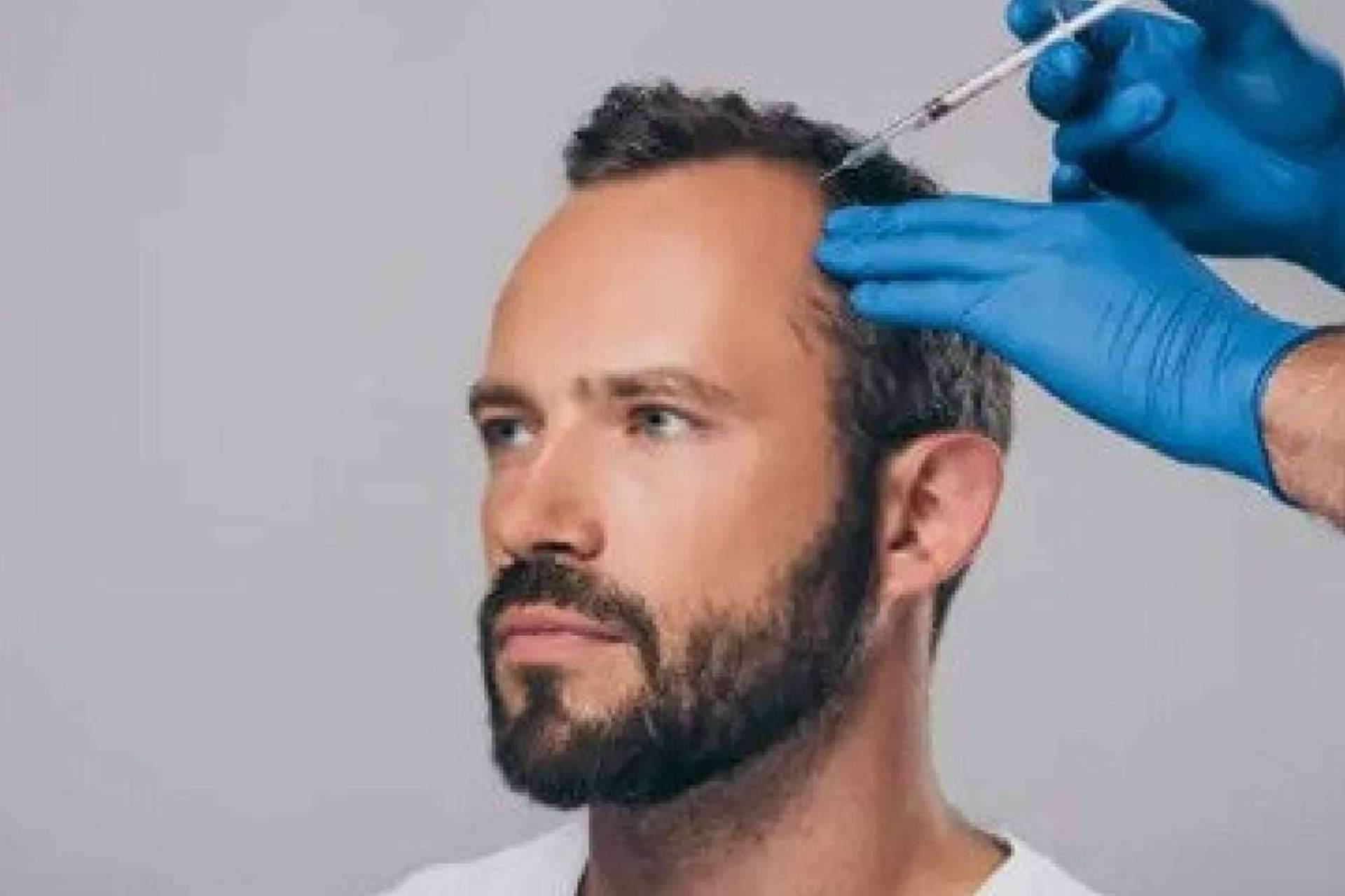 Un tratamiento para la caída del pelo, la mesoterapia capilar