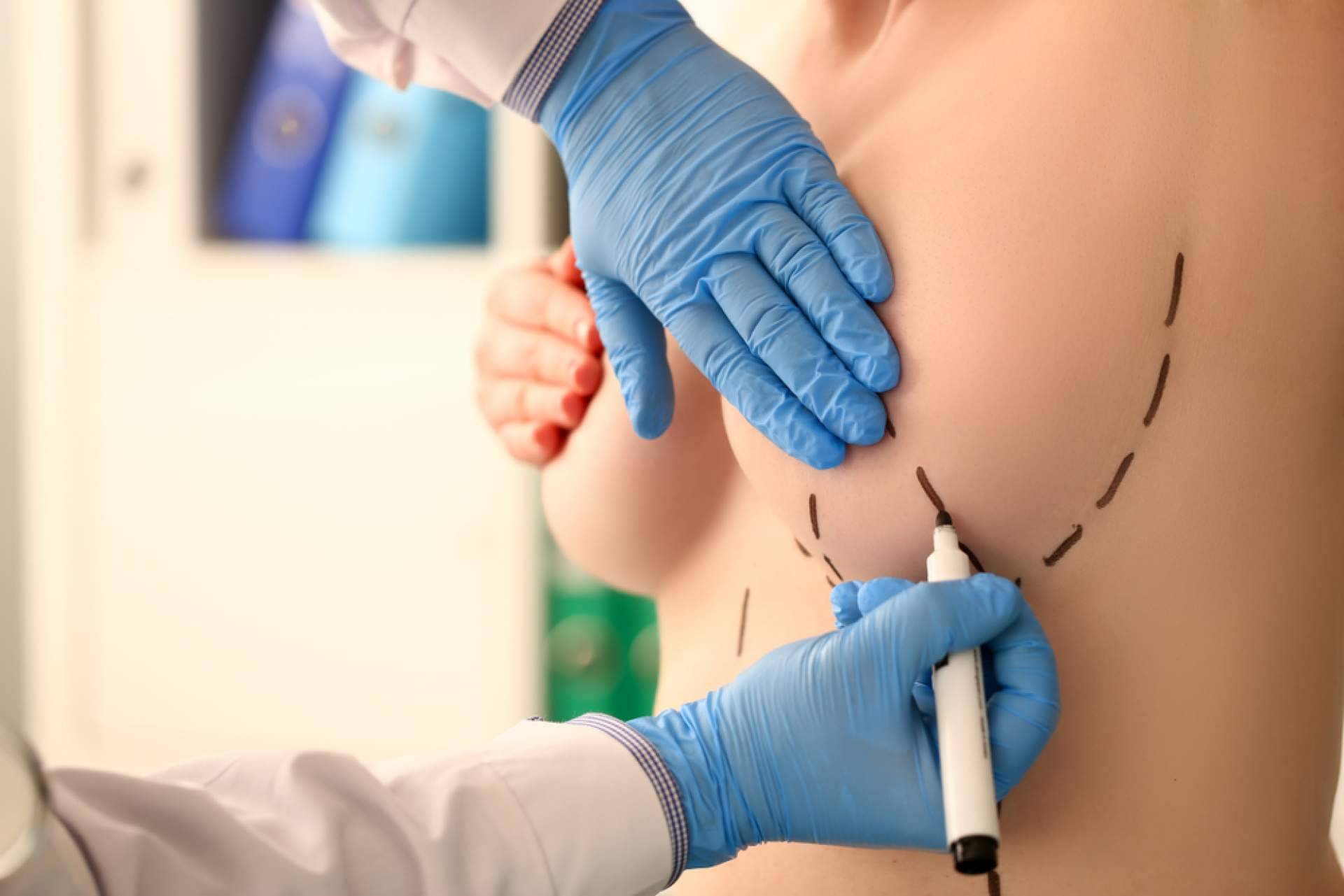 ¿Qué hay que considerar antes de hacerse un aumento de mamas?, con A2Clinic