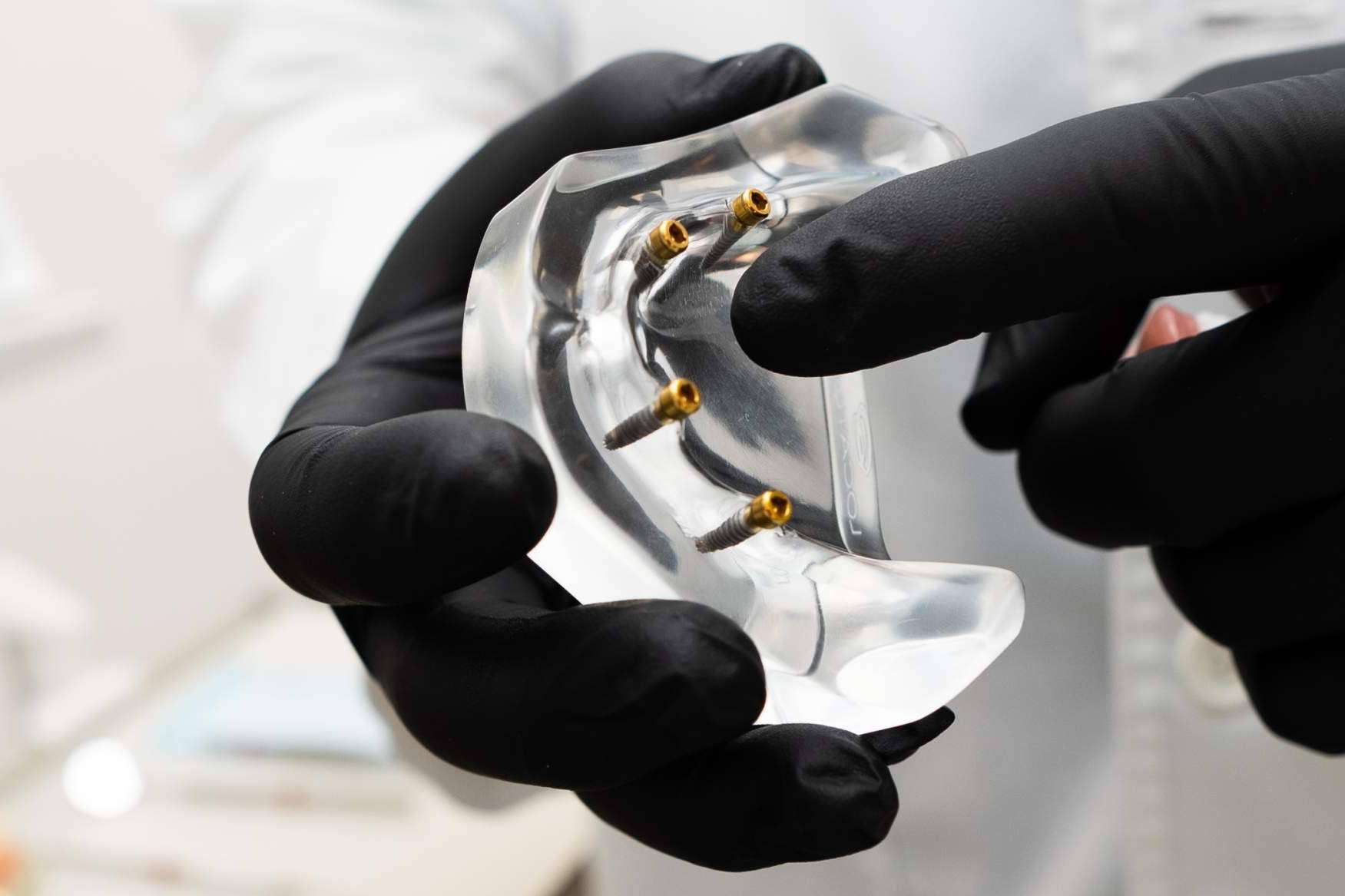 Todo sobre los implantes dentales de la Clínica Calvo de Mora