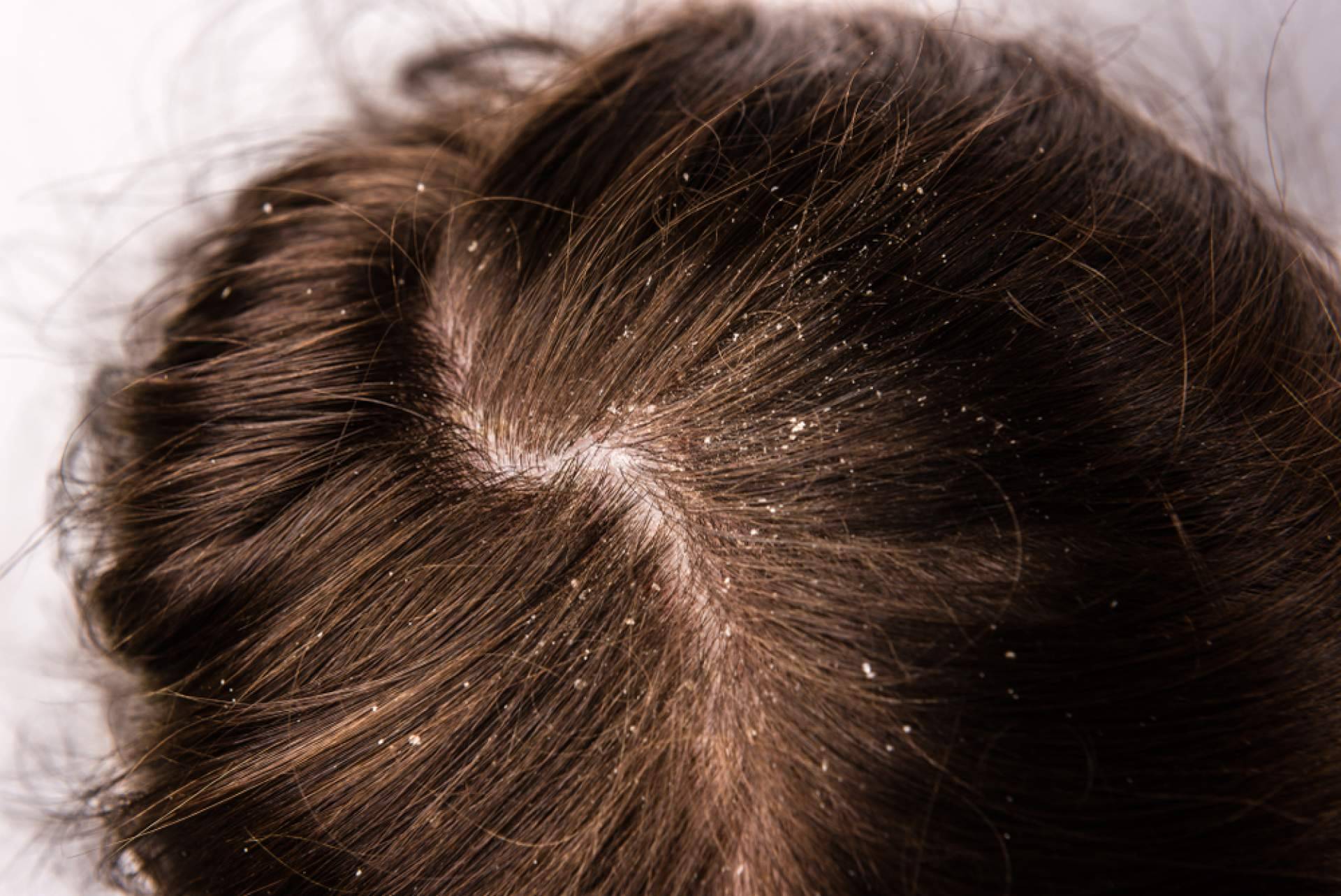 ¿Cuáles son los beneficios del peeling capilar?, por Malecare