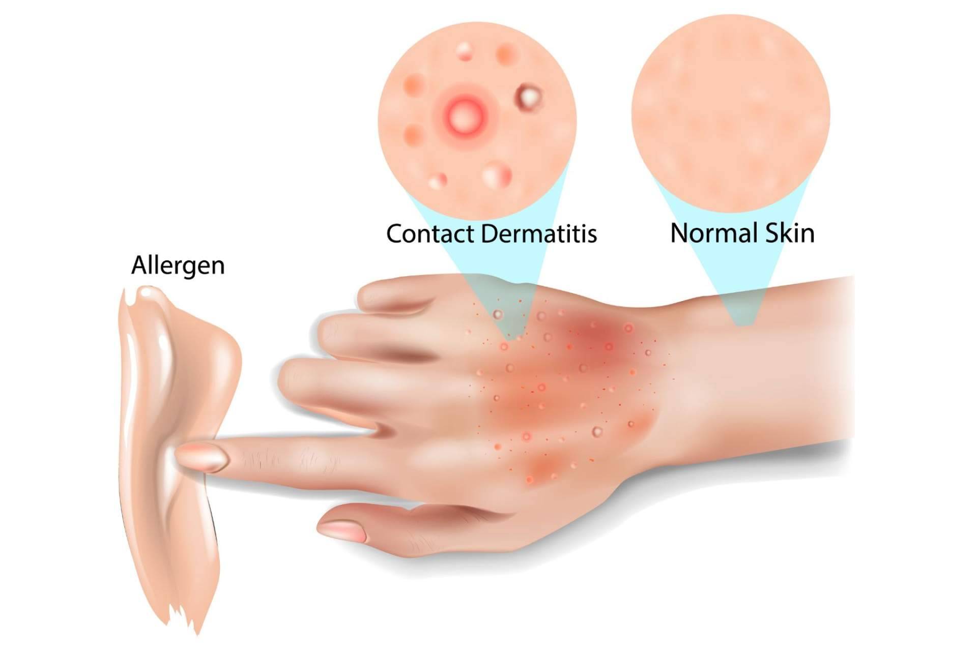 eQuaid Pomada es una solución rápida y eficaz para la dermatitis
