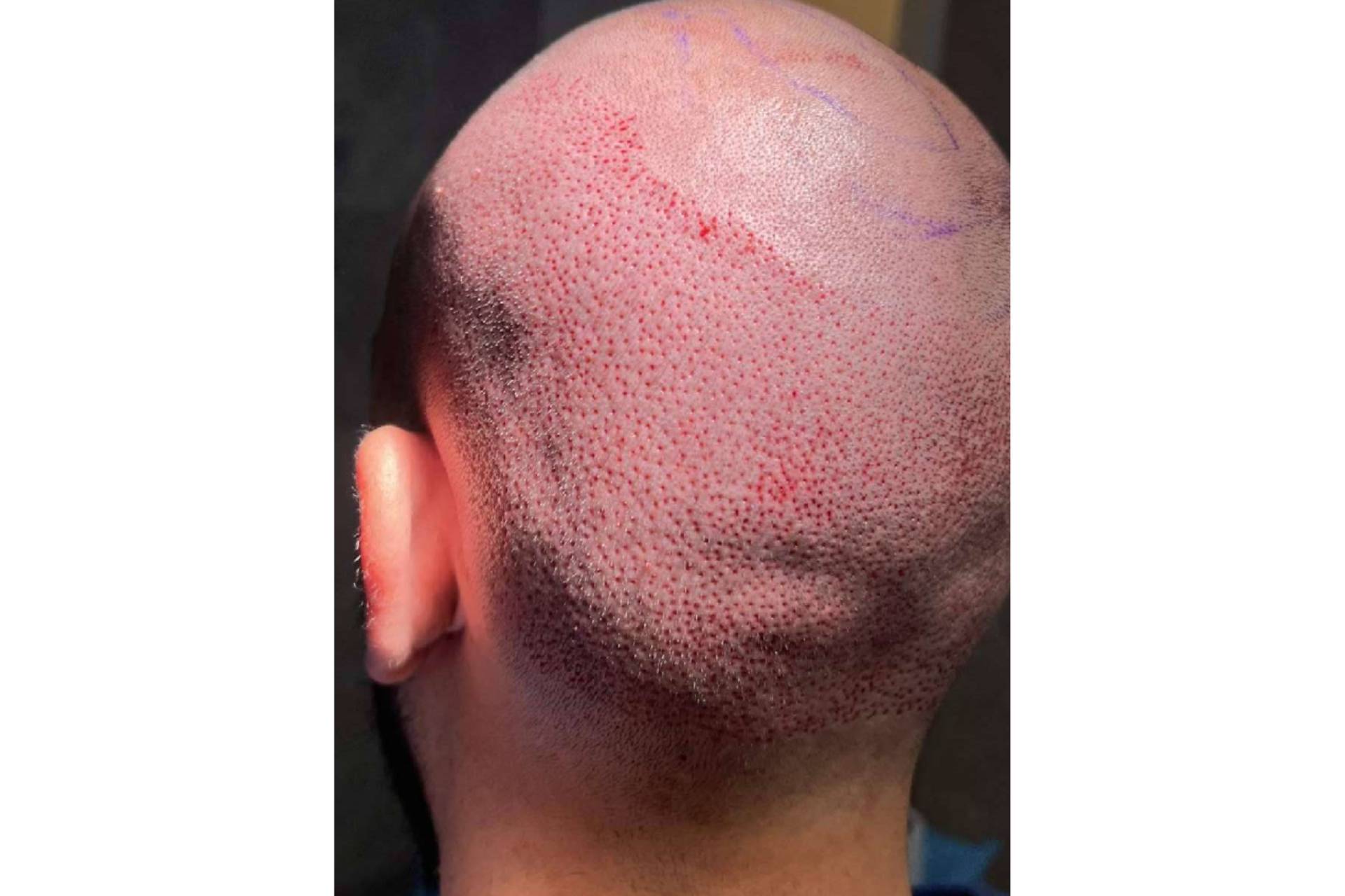 La técnica FUE y el injerto capilar en Barcelona, procedimiento que el Dr. Chara realiza con punchs de 0,7mm