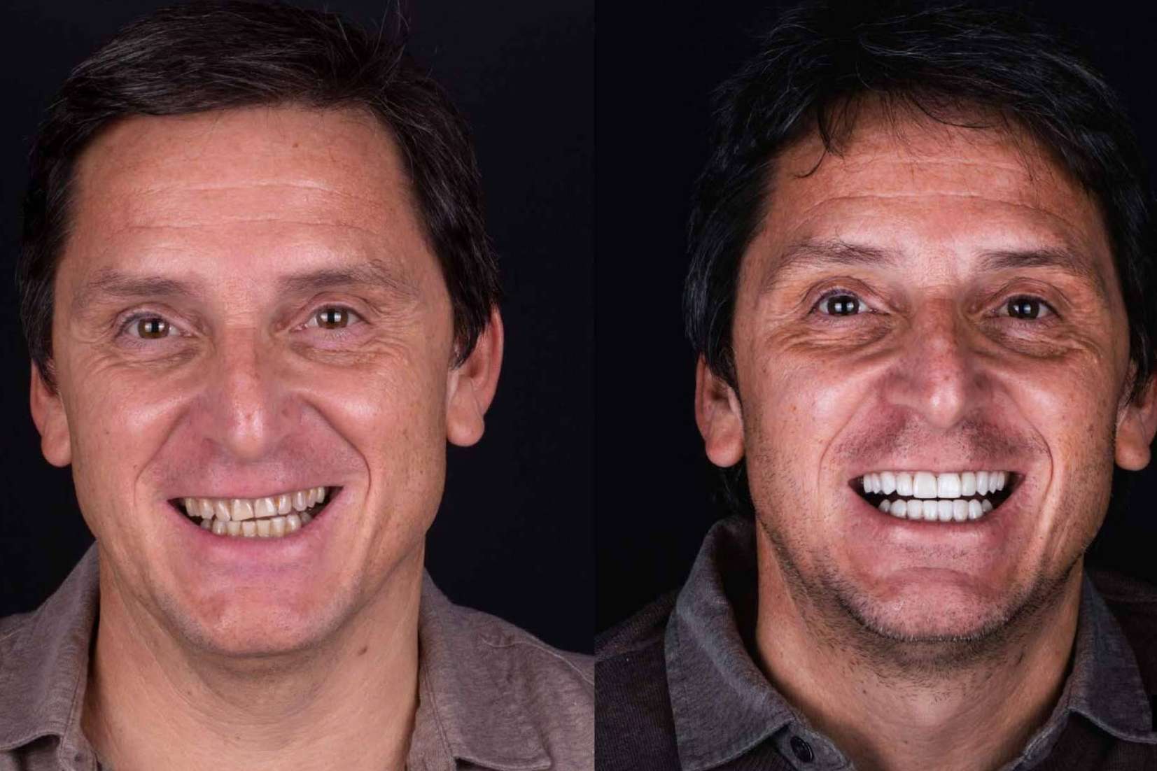 Carillas estéticas transforman el cuidado dental hacia una sonrisa de cine