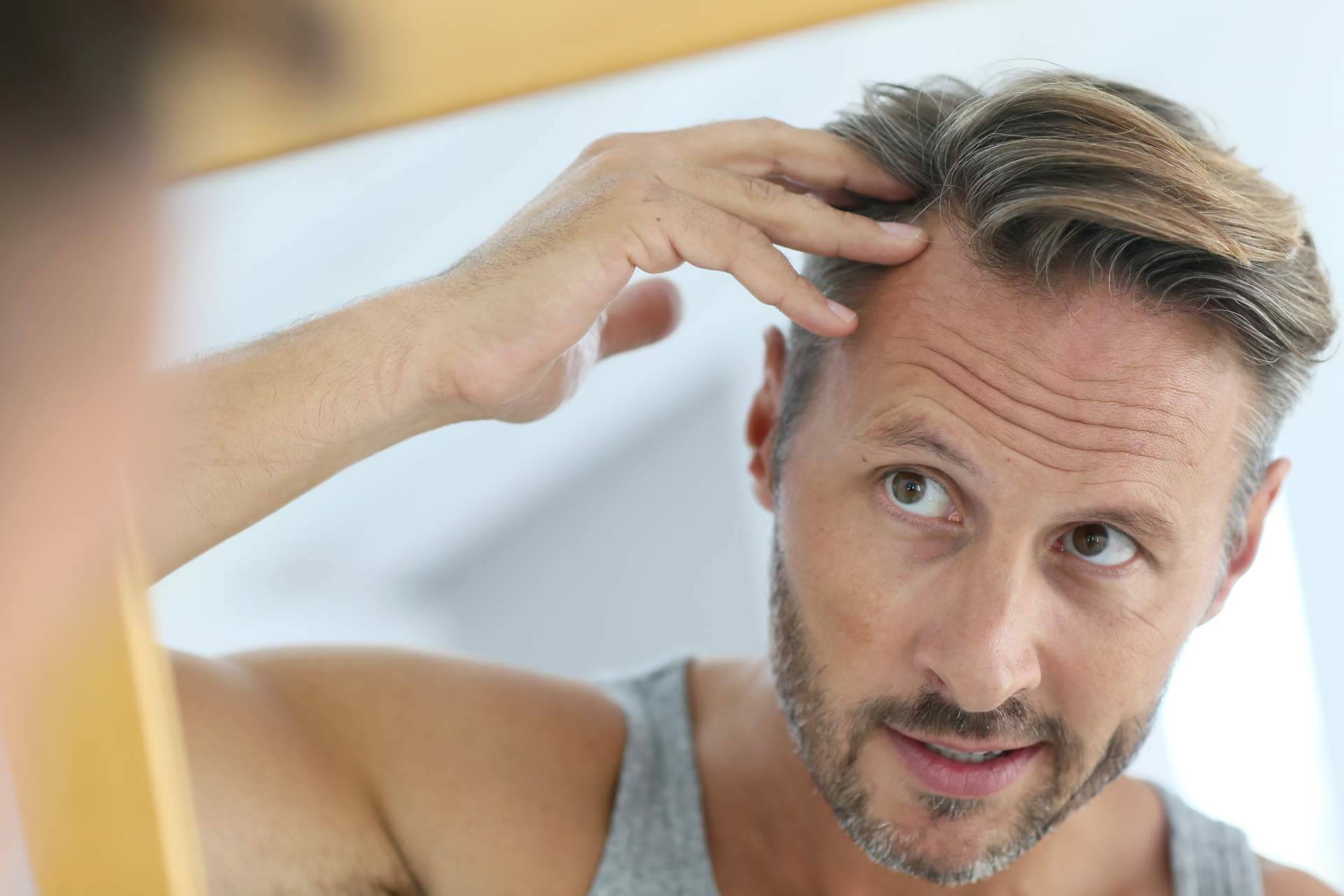 Tratamientos para la alopecia androgénica con Saw palmetto