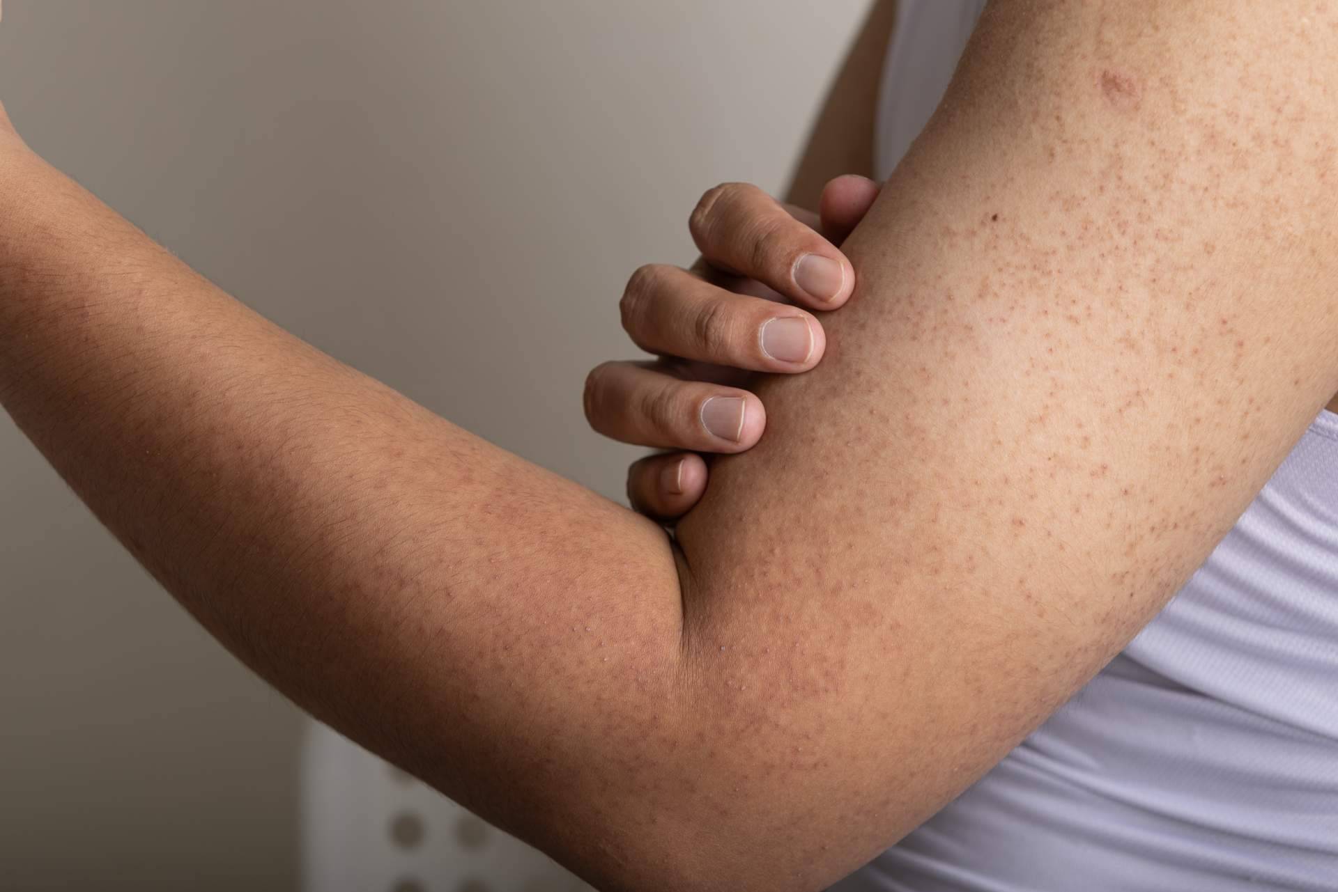 Cómo mitigar los síntomas de la queratosis pilaris, por la Dra. Janeth Arévalo