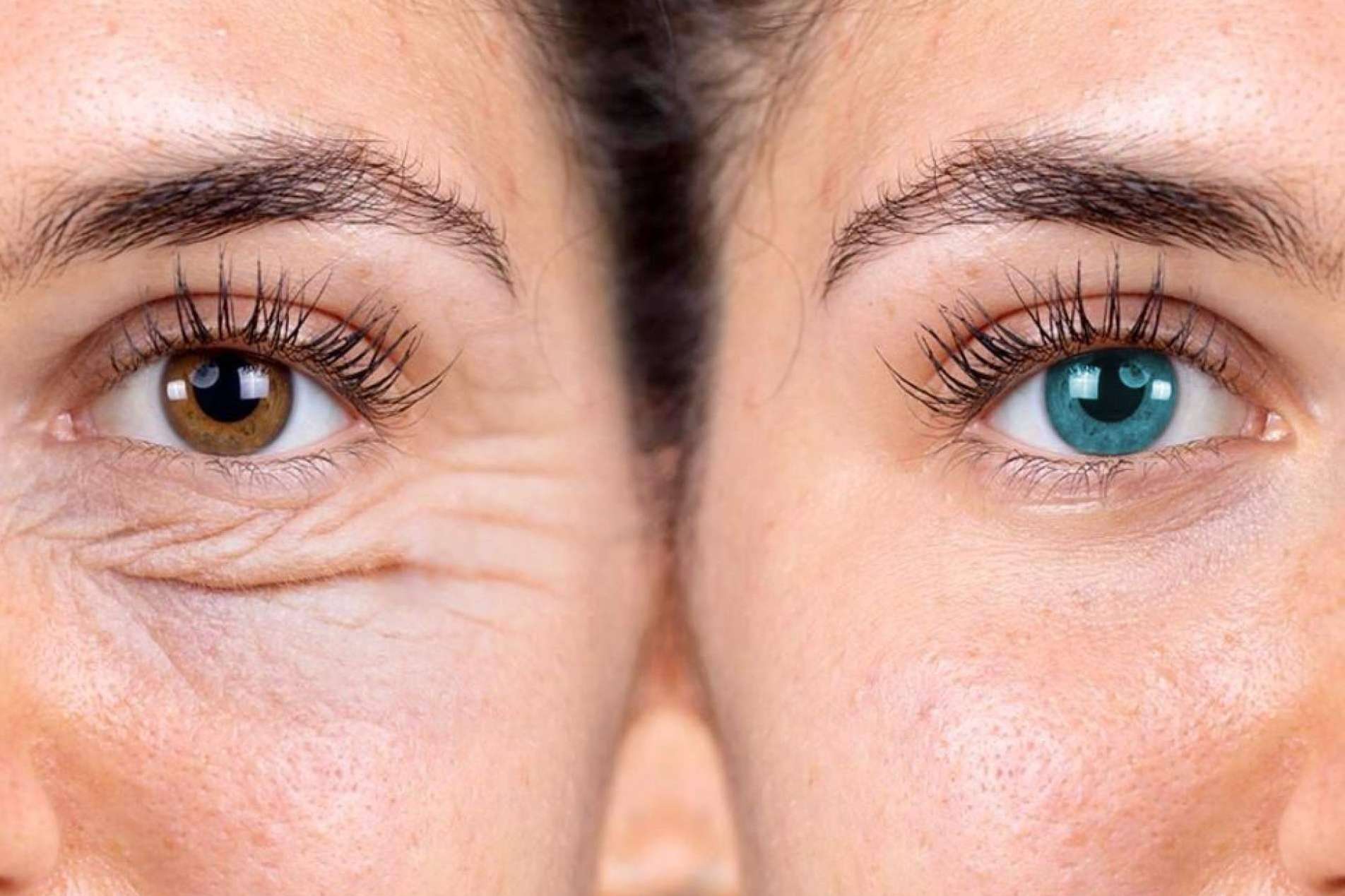 Las ventajas que ofrecen las blefaroplastias con láser sin cirugía