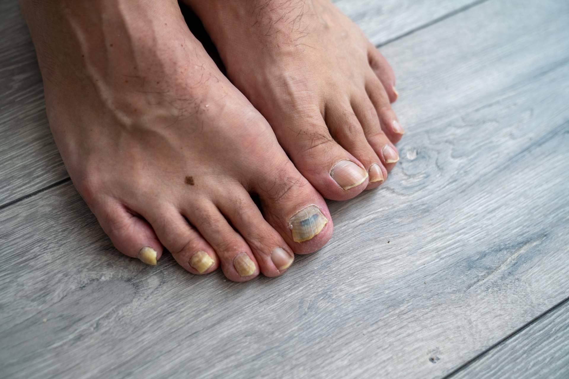 Laboratoires Bailleul ofrece consejos para la prevención de la onicomicosis en verano