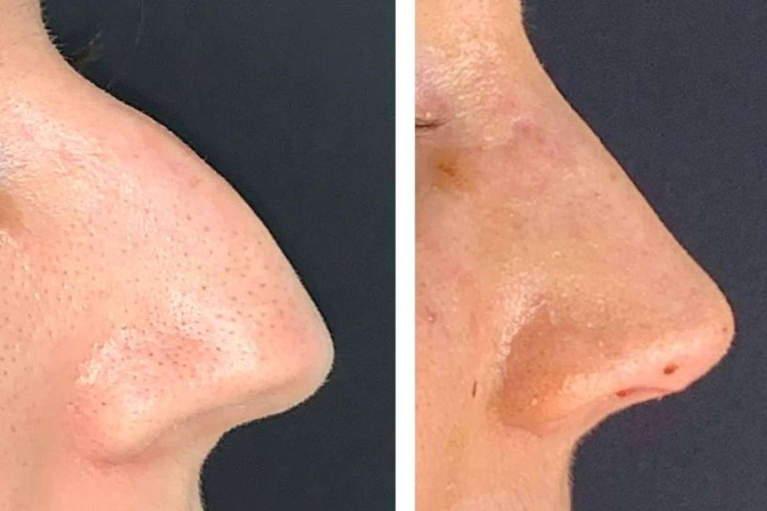 Clínica Menorca, centro especializado en rinoplastia ultrasónica en Madrid