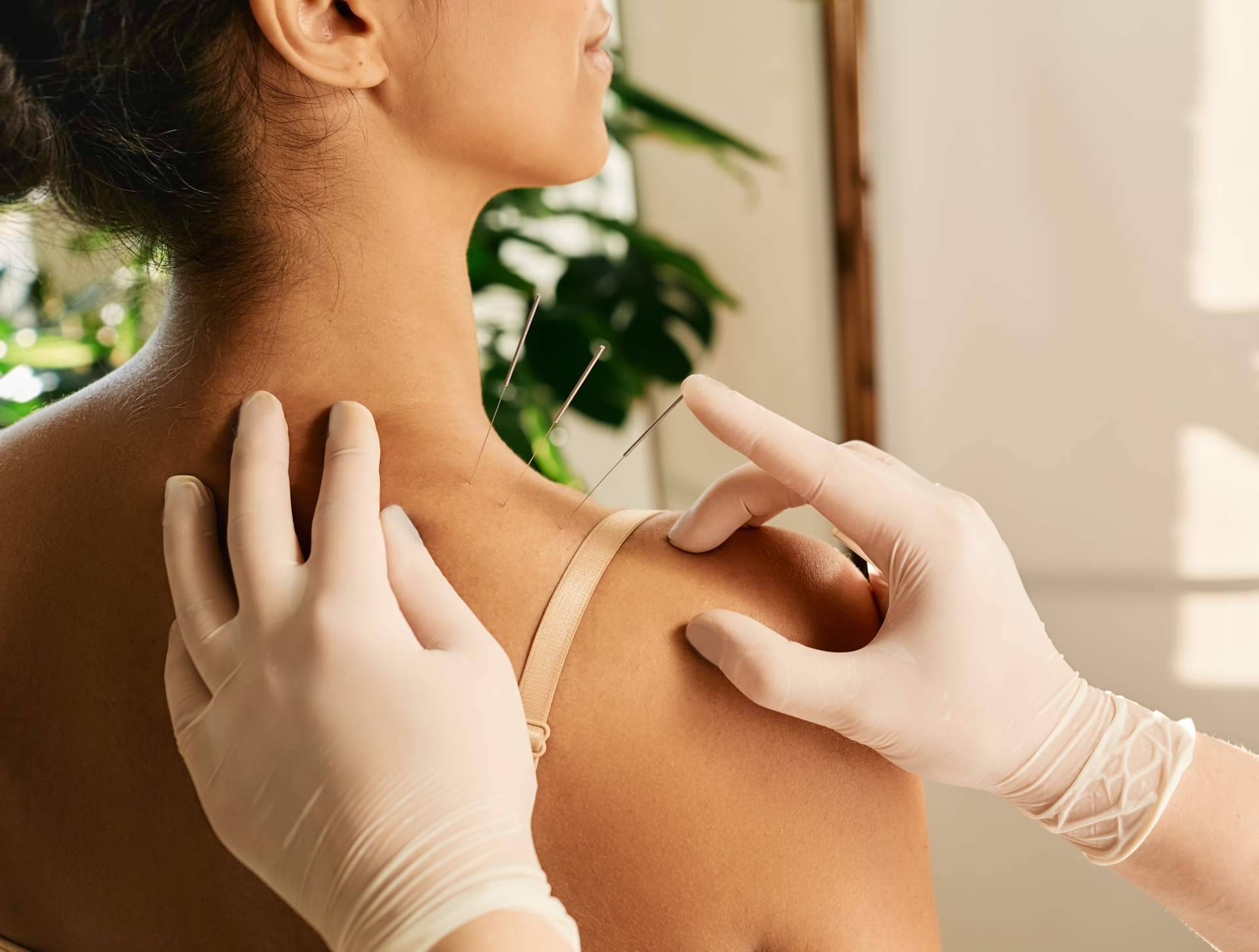 Tratamientos personalizados de acupuntura en Málaga de la mano de Vital Balance