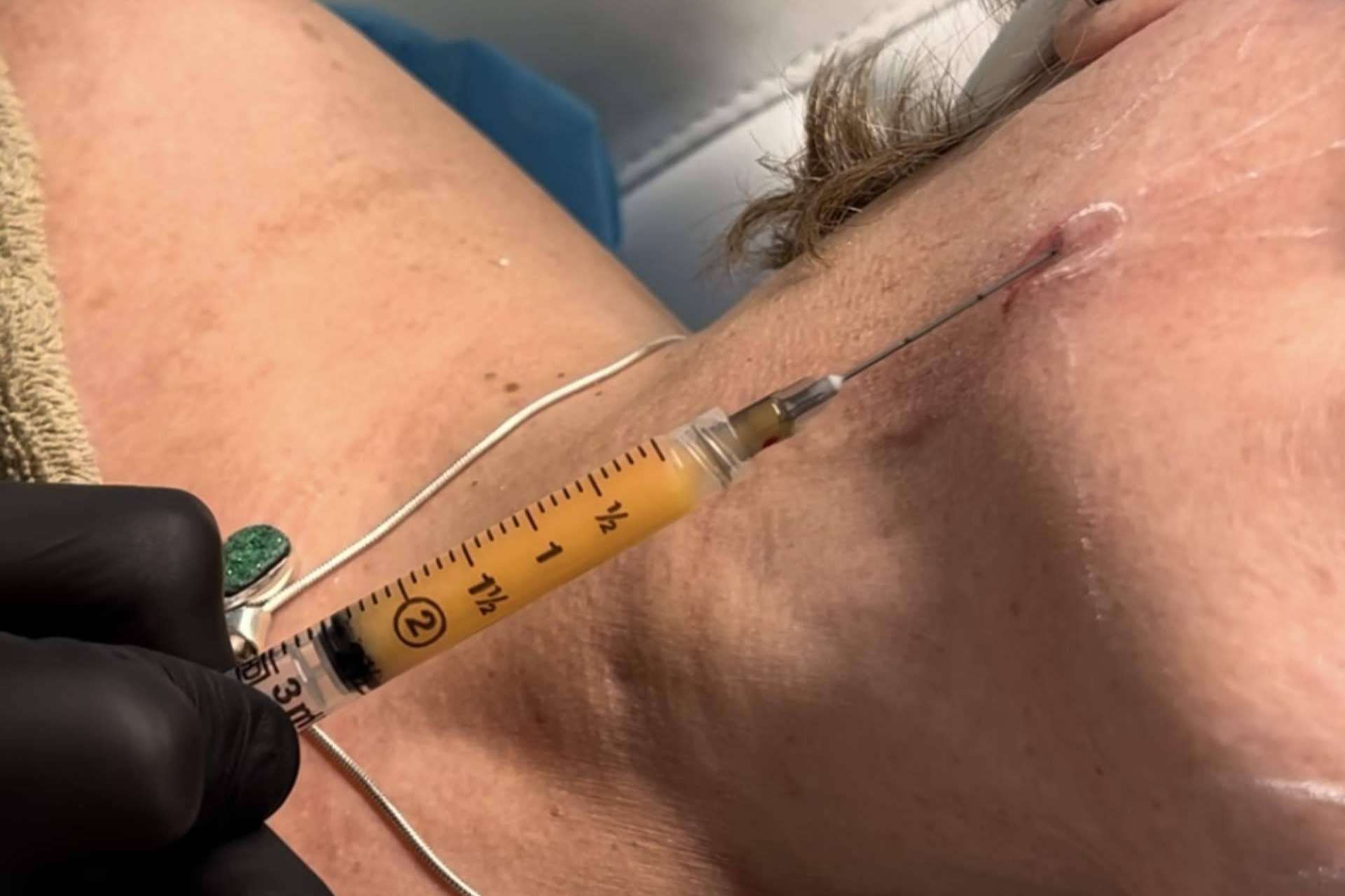 SEFFILLER®️ llega a MD Cliniques; regeneración cutánea con tejido graso propio