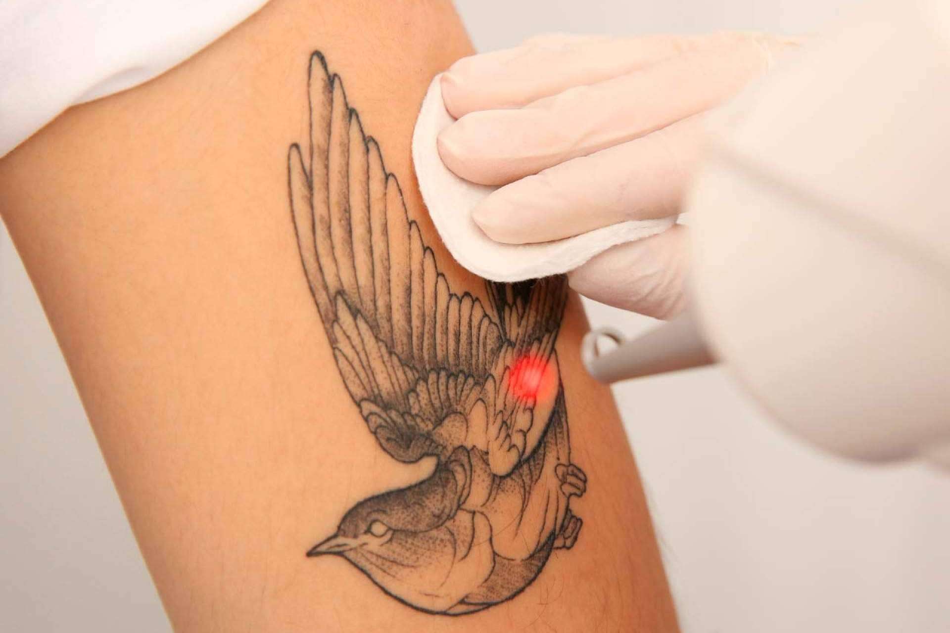 360Clinics revoluciona la eliminación de tatuajes con picolaser, un método eficaz y seguro