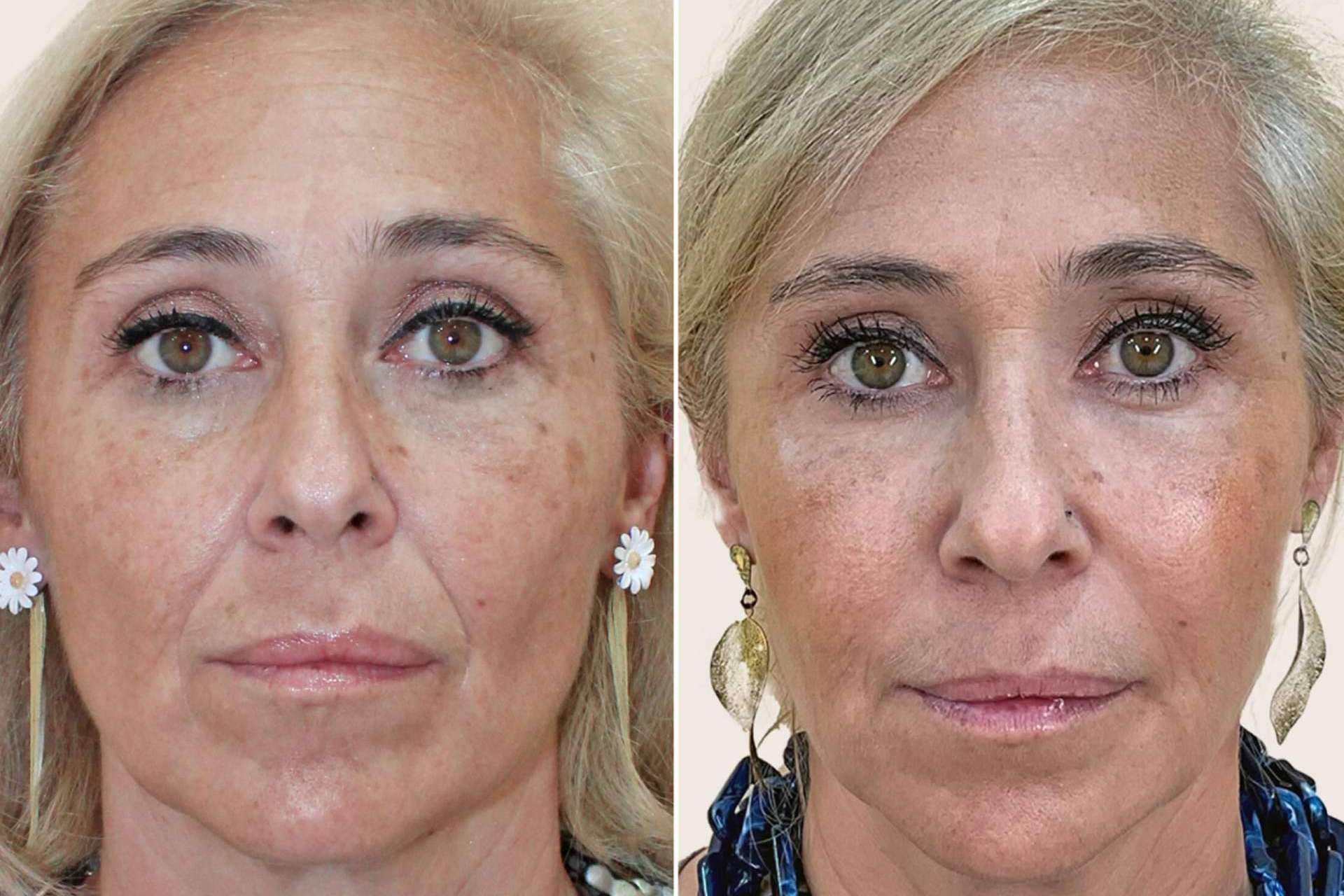 Armonización facial, el secreto de belleza que triunfa entre las 'celebs' mayores de 40