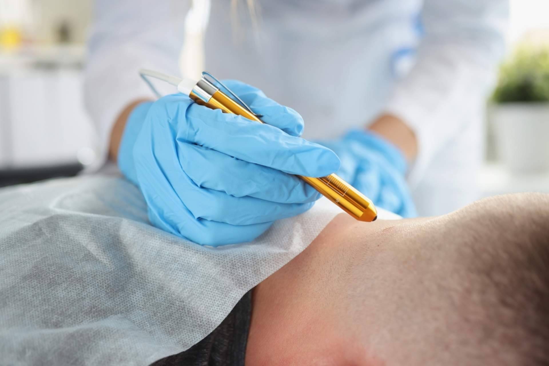 Eliminar lunares y verrugas de forma personalizada y sin marcas, la propuesta del Centro Estética El Pilar