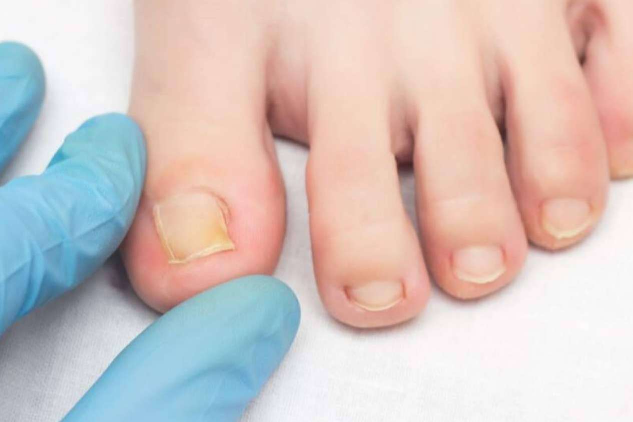 Laboratoires Bailleul lanza Mycogel, gel limpiador para tratar micosis y hongos del pie de atleta