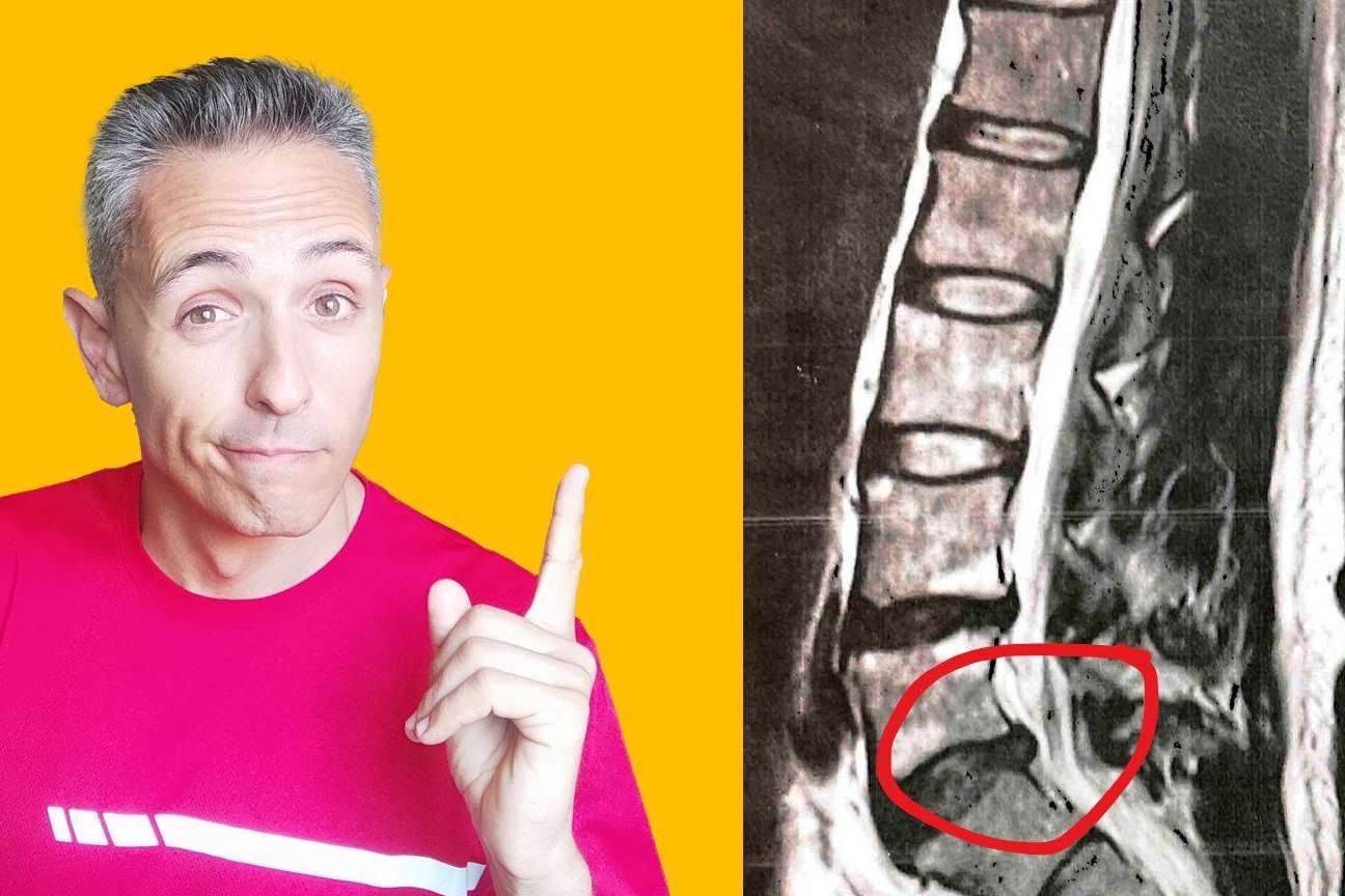 Roberto Galván destaca el enfoque más eficaz para el tratamiento de la hernia discal L5-S1