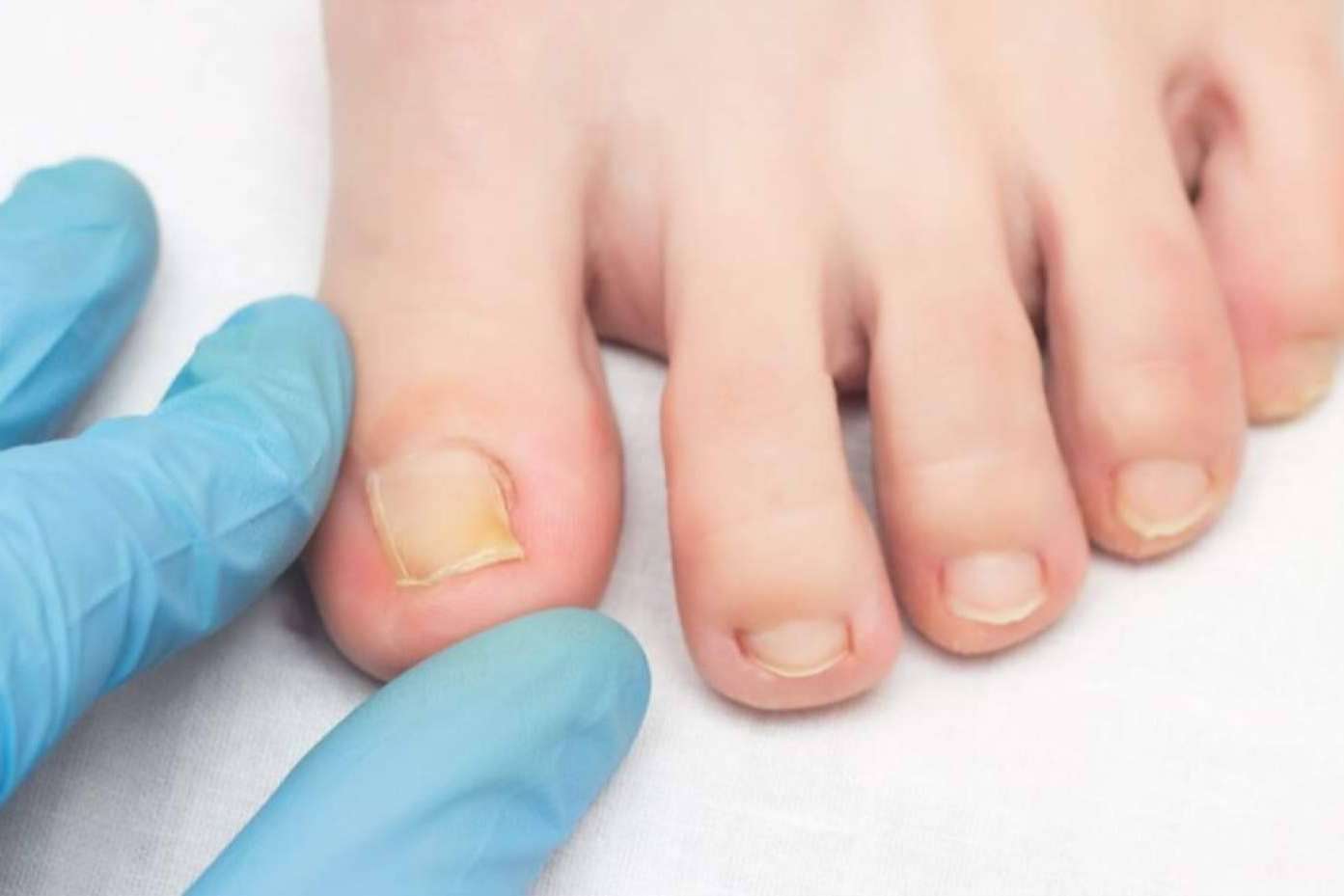 Mycogel, higiene suave y eficaz frente a hongos y micosis