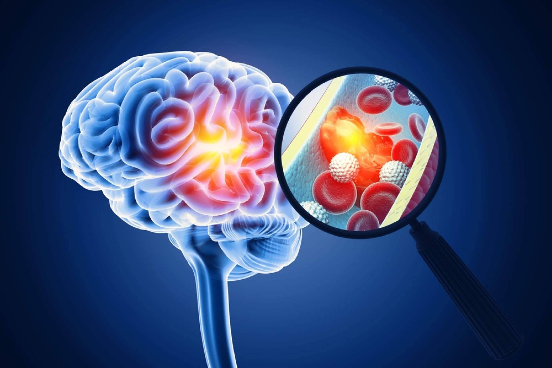 El diagnóstico temprano del ictus marca la diferencia en la evolución funcional del paciente