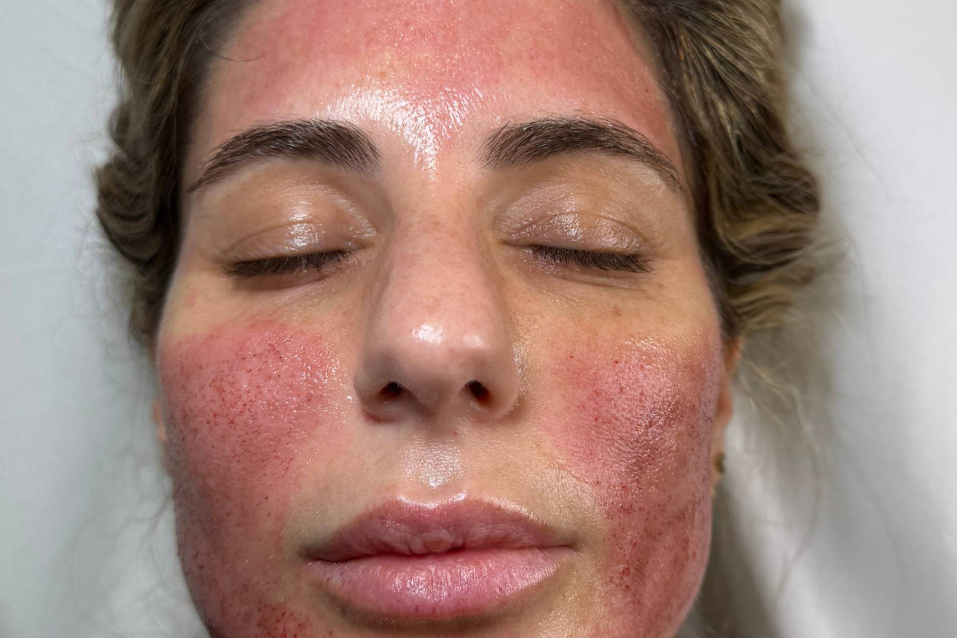 Vampiro facial, el tratamiento médico-estético que estimula la regeneración natural de la piel