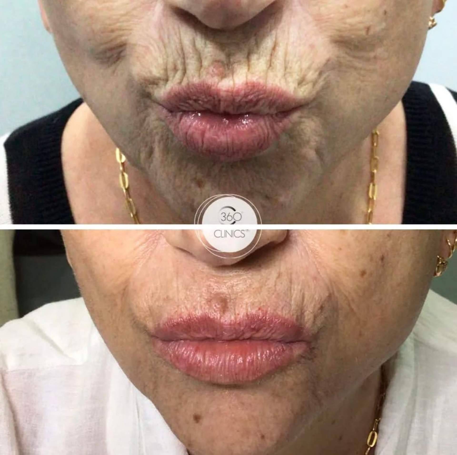 El código de barras; qué es, por qué aparece y cómo eliminarlo con medicina estética
