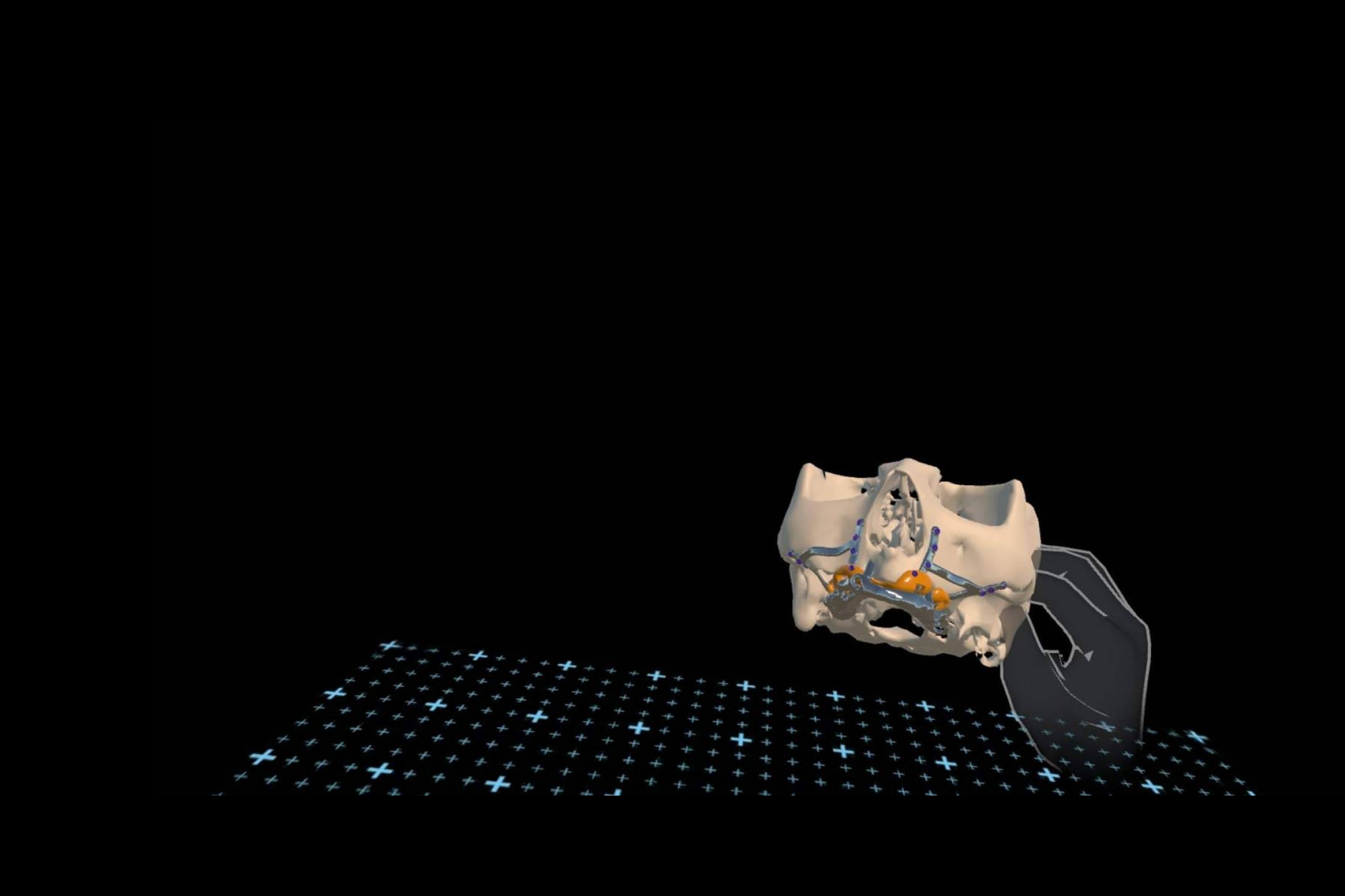 Implantes subperiósticos; la tecnología 3D abre nuevas vías para la rehabilitación dental en maxilares severamente atróficos