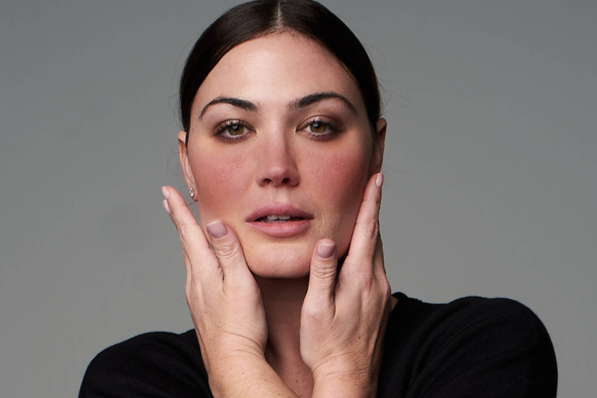 Cuando el rubor repetido socava la autoestima, el laser vascular es una opción a tener en cuenta