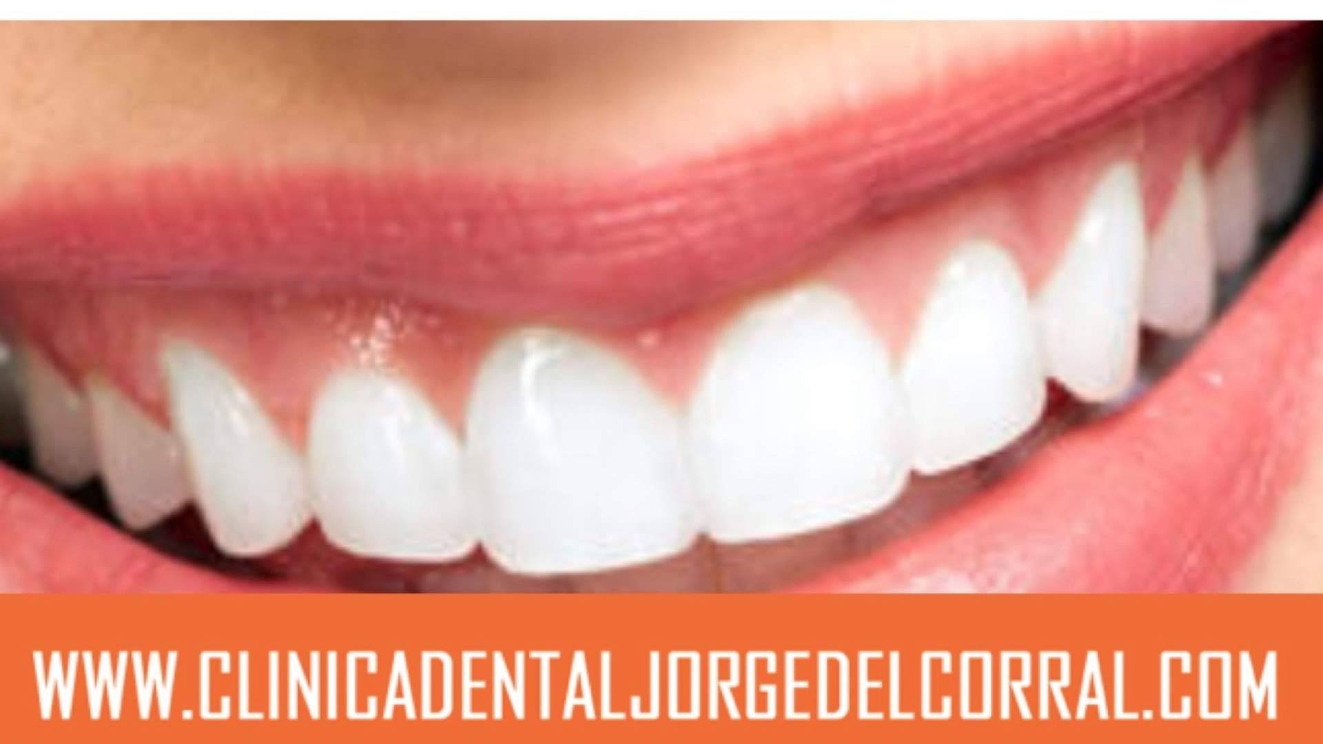 Carillas dentales y prótesis fija sin metal; la tendencia hacia una sonrisa más natural