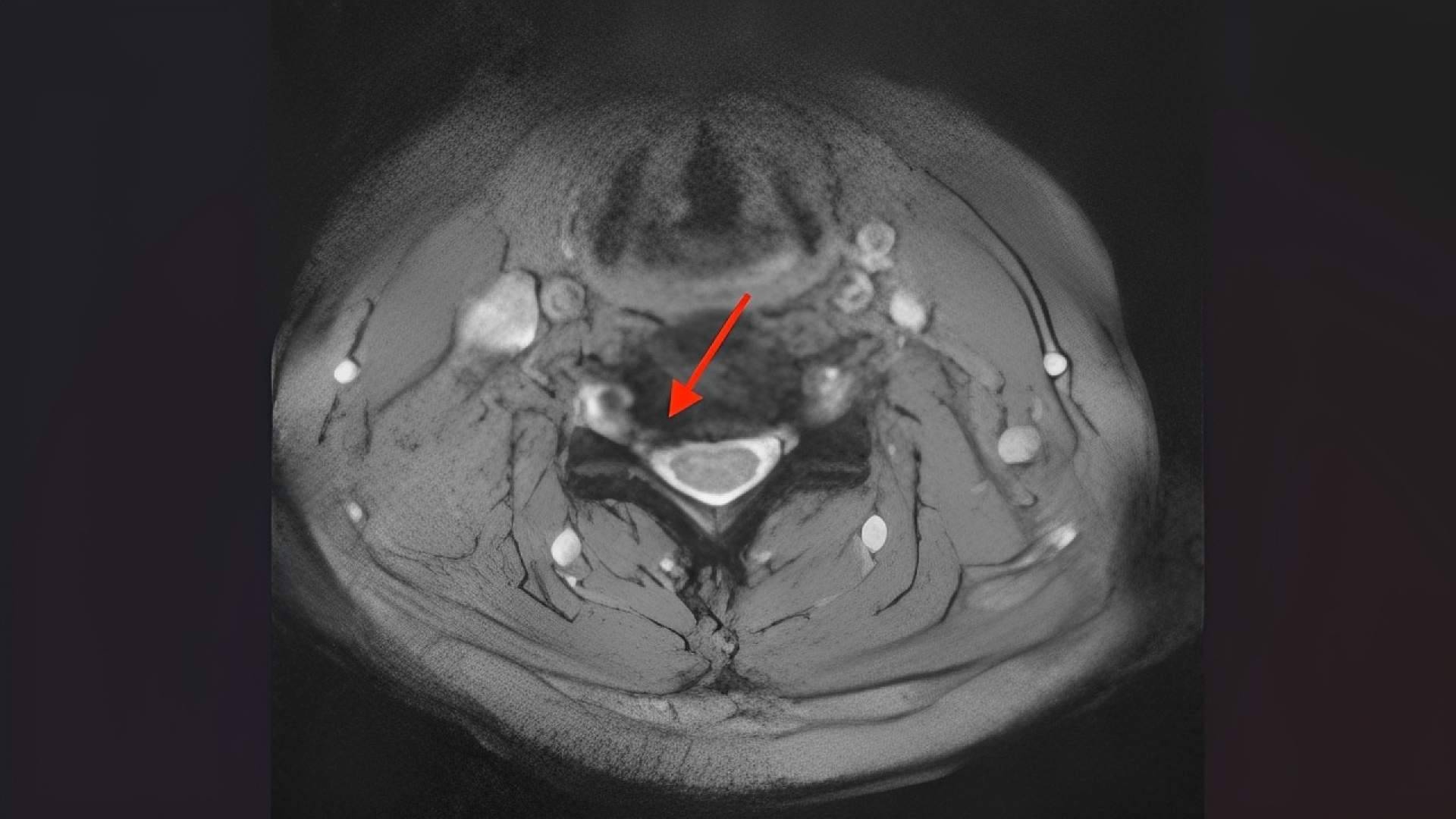 La cirugía endoscópica cervical abre nuevas posibilidades para muchos pacientes con hernias