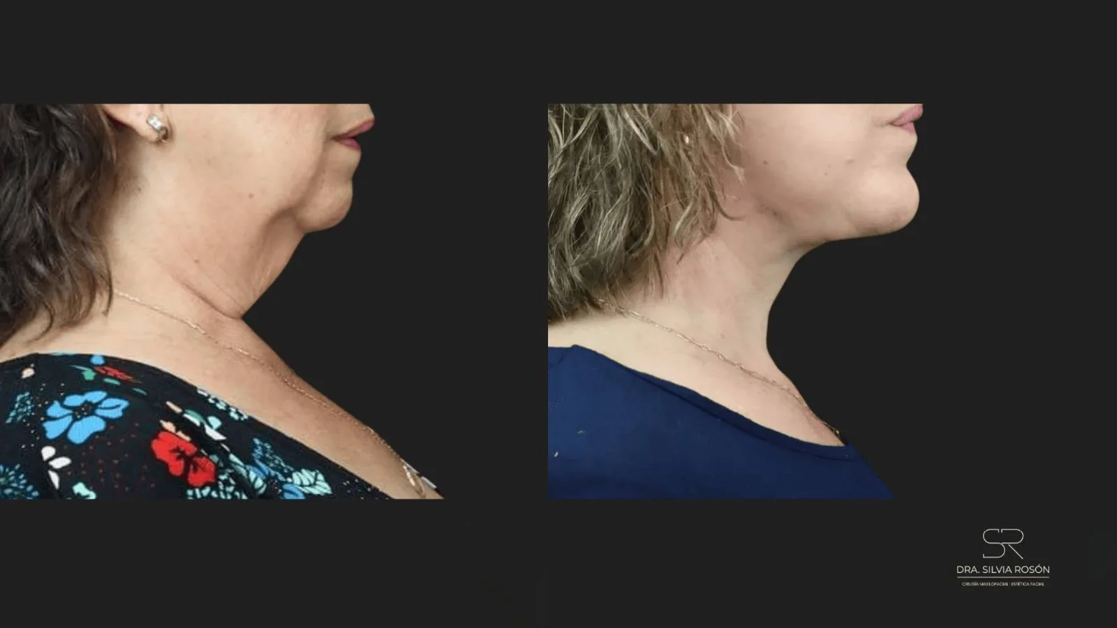 El error del lifting facial no es operar; es tirar en la dirección equivocada